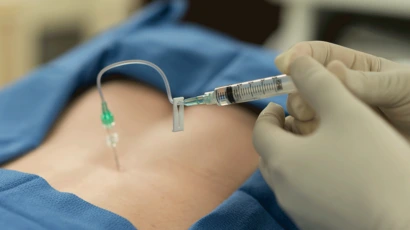 Epidural Steroids Non Surgical