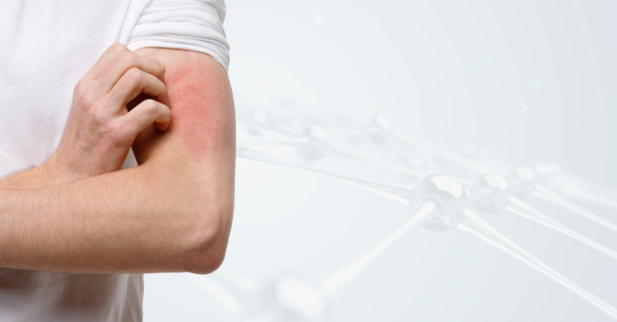 Shingles Postherpetic Neuralgia image